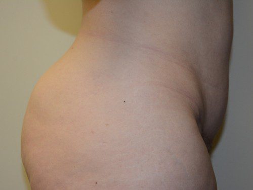 Mini Tummy Tuck After Patient 5