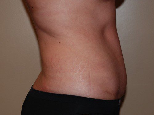 Tummy Tuck After Patient 4