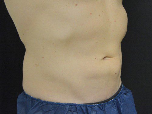 Coolsculpting After Patient 3