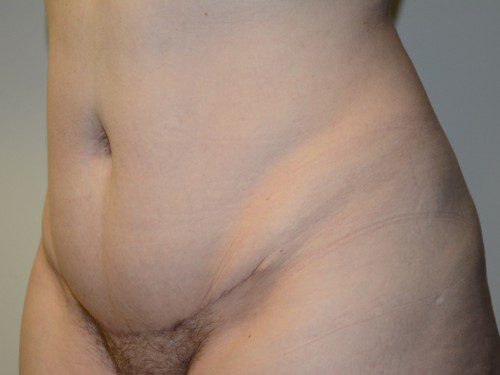 Mini Tummy Tuck After Patient 2