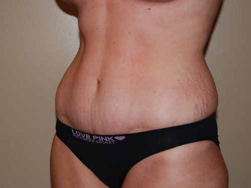 Tummy Tuck After Patient 3