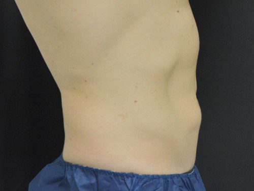 Coolsculpting After Patient 5