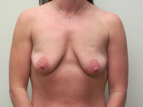 Breast Augmentation w/Lift Before Patient 1