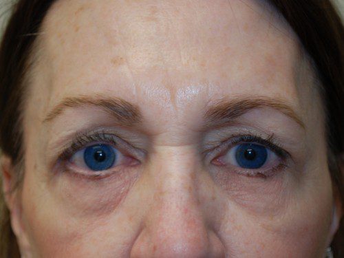 Eyelid Surgery Before Patient 1