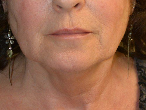 Facelift Before Patient 1