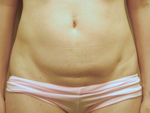 Mini Tummy Tuck Before Patient 1