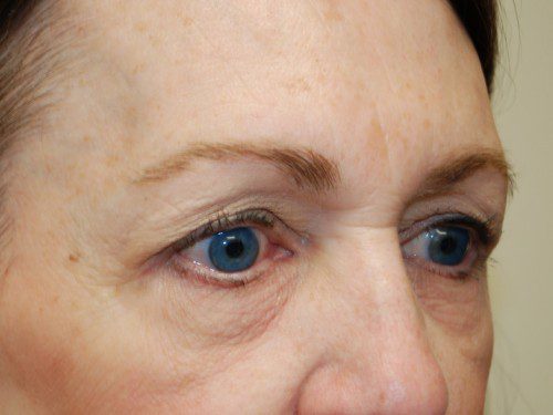 Eyelid Surgery Before Patient 2