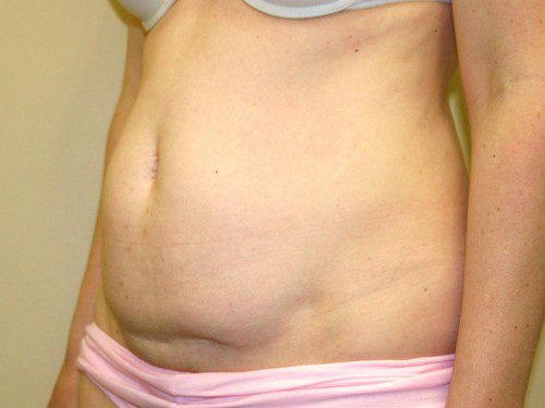 Mini Tummy Tuck Before Patient 2