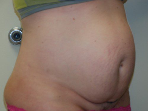 Tummy Tuck Before Patient 2