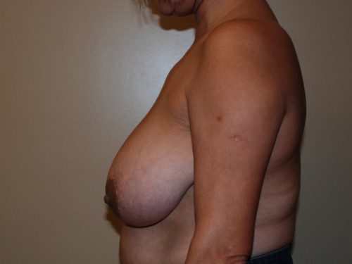 Breast Reduction Before Patient 4