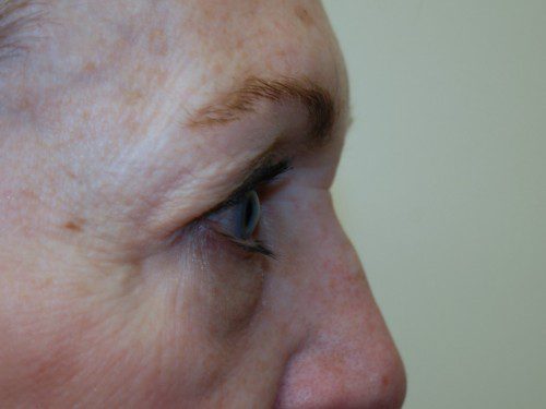 Eyelid Surgery Before Patient 4