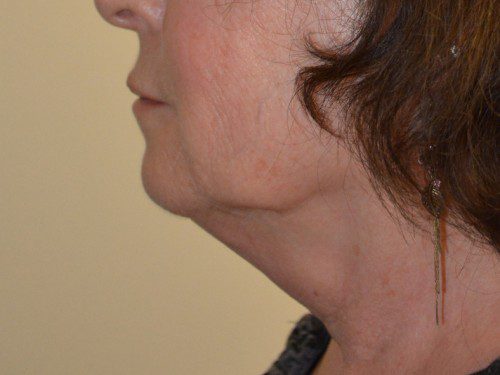 Facelift Before Patient 4