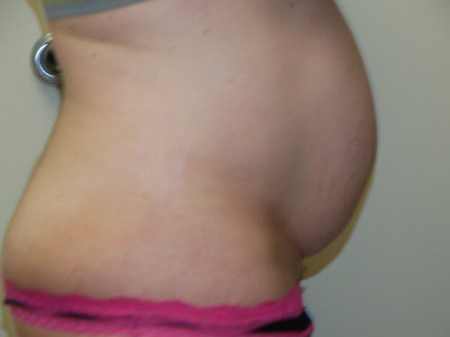 Tummy Tuck Before Patient 4