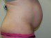 Tummy Tuck Before Patient Thumbnail 4