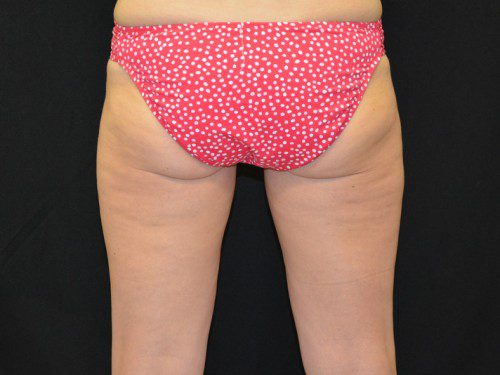 Coolsculpting After Patient 2