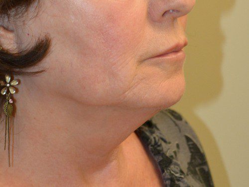 Facelift Before Patient 3