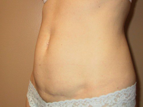 Mini Tummy Tuck After Patient 2