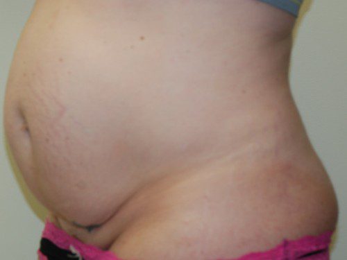 Tummy Tuck Before Patient 3