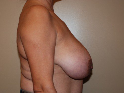 Breast Reduction Before Patient 5