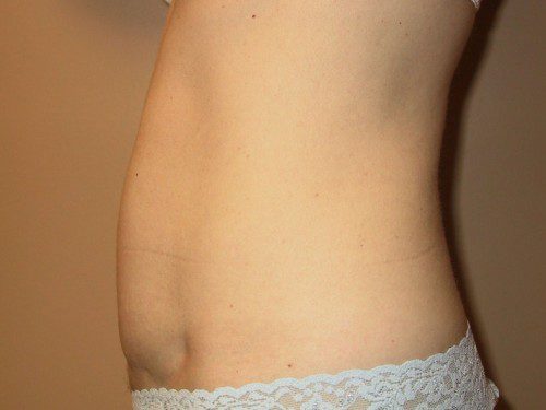 Mini Tummy Tuck After Patient 3