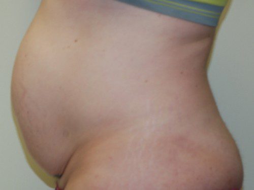 Tummy Tuck Before Patient 5