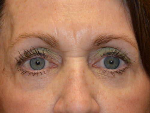 Eyelid Surgery After Patient 1