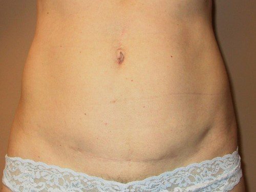 Mini Tummy Tuck After Patient 1