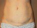 Mini Tummy Tuck After Patient Thumbnail 1