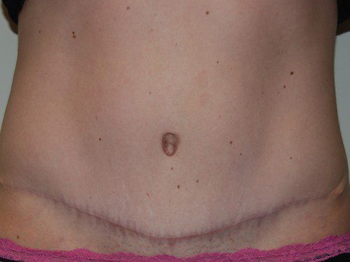 Tummy Tuck After Patient 1