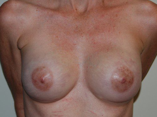 Breast Reconstruction Tissue Expanders After Patient 1