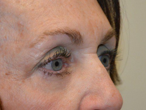 Eyelid Surgery After Patient 2