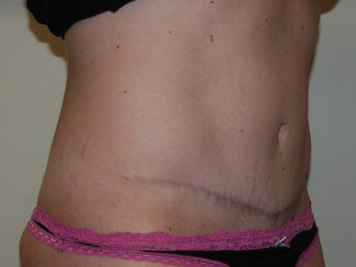 Tummy Tuck After Patient 2