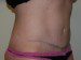 Tummy Tuck After Patient Thumbnail 2