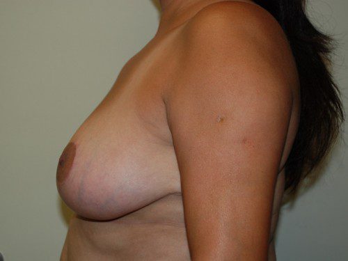 Breast Reduction After Patient 4