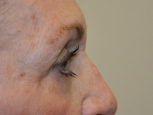 Eyelid Surgery After Patient 4