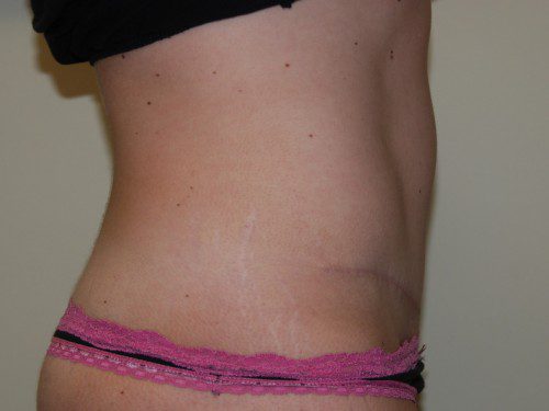 Tummy Tuck After Patient 4