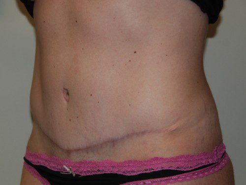 Tummy Tuck After Patient 3