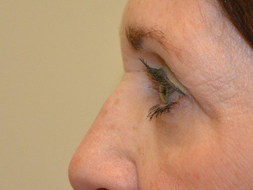Eyelid Surgery After Patient 5