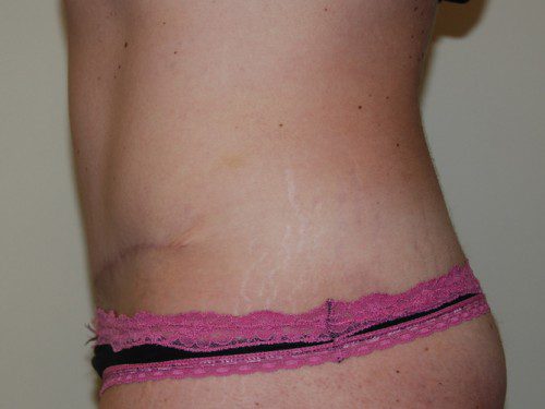 Tummy Tuck After Patient 5