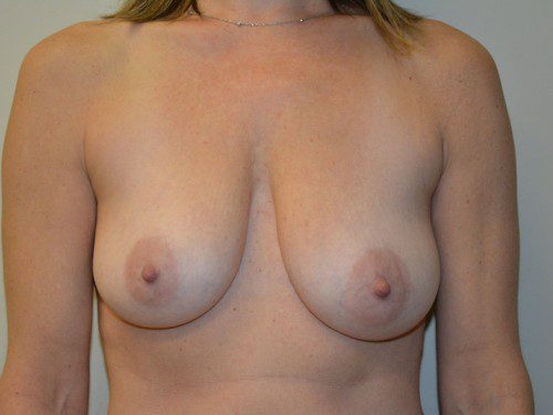 Breast Augmentation w/Lift Before Patient 1