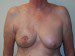 Breast Reconstruction Tissue Expanders Before Patient Thumbnail 1