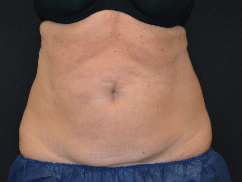 Coolsculpting Before Patient 1