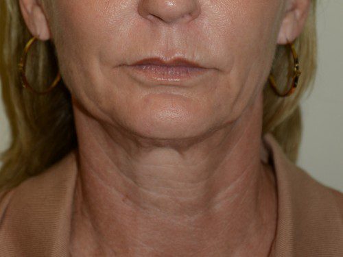 Facelift Before Patient 1