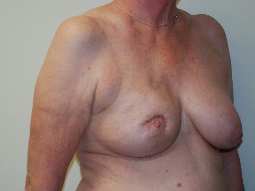 Breast Reconstruction Tissue Expanders Before Patient 2