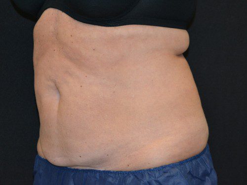 Coolsculpting Before Patient 2