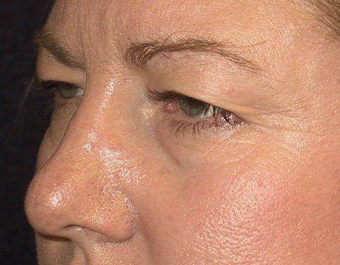 Eyelid Surgery Before Patient 2