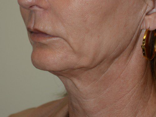 Facelift Before Patient 2