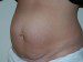 Tummy Tuck Before Patient Thumbnail 2