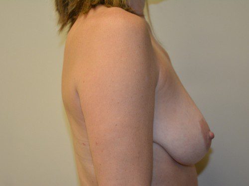 Breast Augmentation w/Lift Before Patient 4