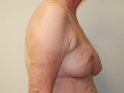 Breast Reconstruction Tissue Expanders Before Patient 4